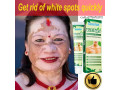 skin-whitening-products-in-serangoon-town-in-singapore-call-27710732372-scarsstretch-marks-removal-in-rustenburg-south-africa-small-0