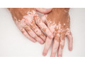 2771-073-2372-get-rid-of-vitiligo-in-west-melbourne-city-in-florida-and-vaasa-city-in-finland-small-4